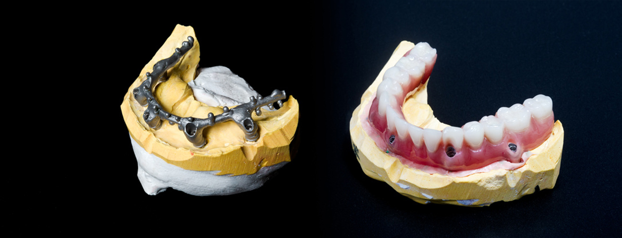 Implant Dentures