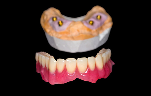 implant-denture